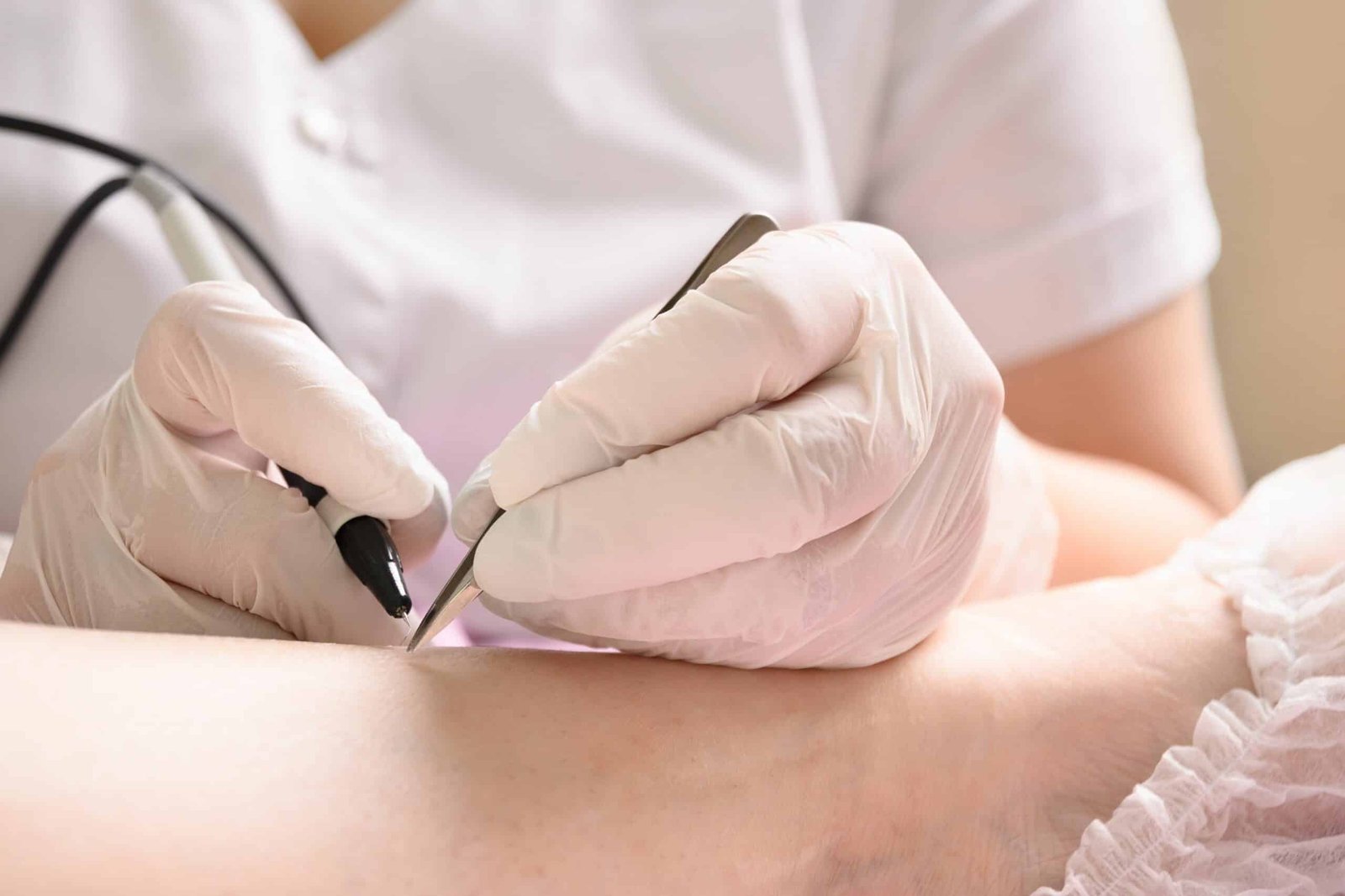 epilation définitive