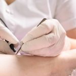 epilation définitive